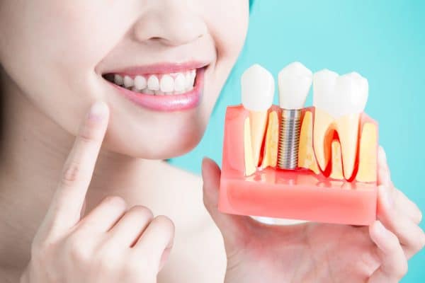 dental-implants-procedure