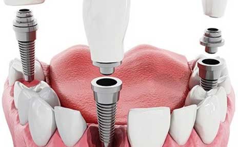 best dental implants in melbourne, VIC