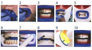 In-Chair Teeth Whitening Procedure