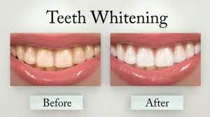 Teeth Whitening Procedure before after