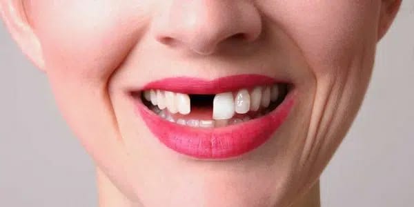 missing-teeth-treatment-dental-implant