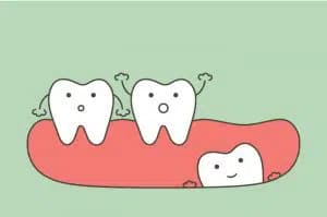 remove-impacted-wisdom-tooth