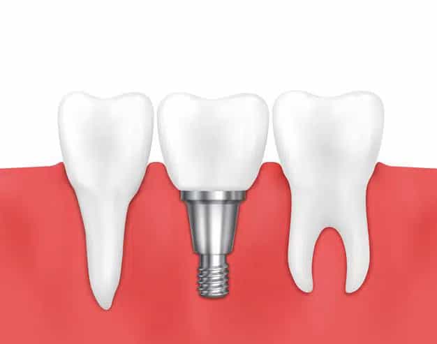 teeth implants