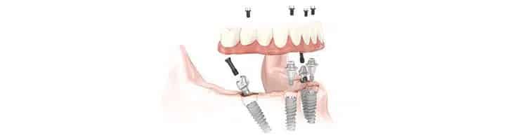 pros-cons-all-on-4-dental-implants