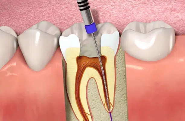 Root Canal Treatment cost melbourne